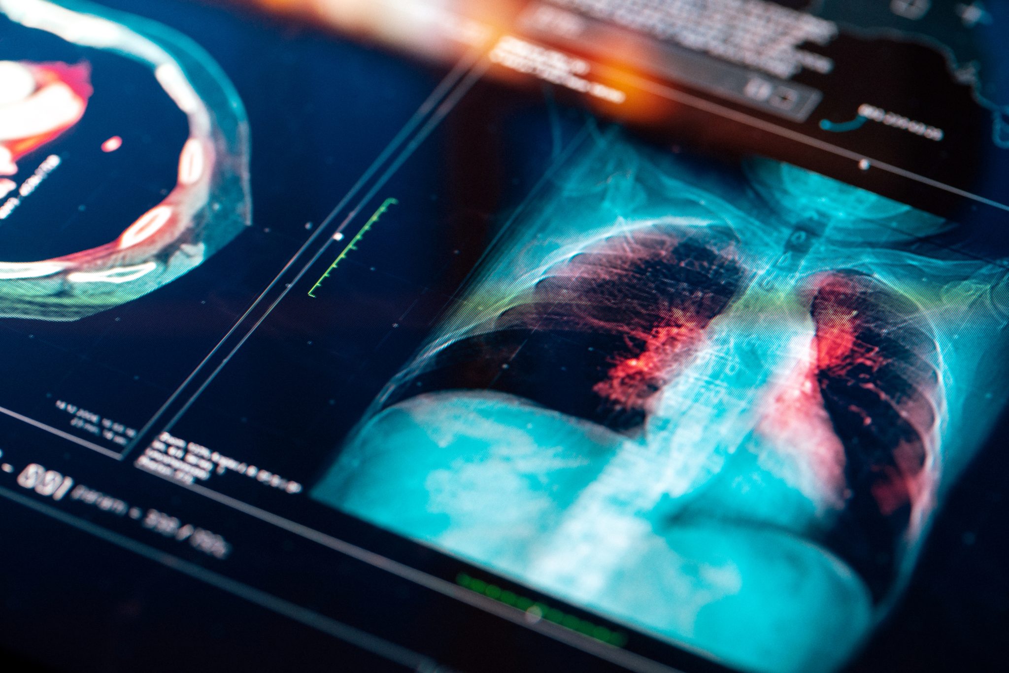 Lung Cancer Screening | Low Dose CT Chest | Link Radiology - Link Radiology
